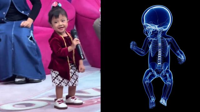 Diidap Kreator Cilik Zehan Almira, Apa Itu Penyakit Osteogenesis Imperfekta?